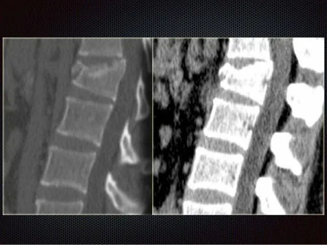 Компрессионный оскольчатый перелом позвоночника l1. Компрессионный перелом позвоночника l5. Компрессионный перелом l5 позвонка рентген. Оскольчатый перелом позвоночника кт. Компрессионный перелом тела 1 1