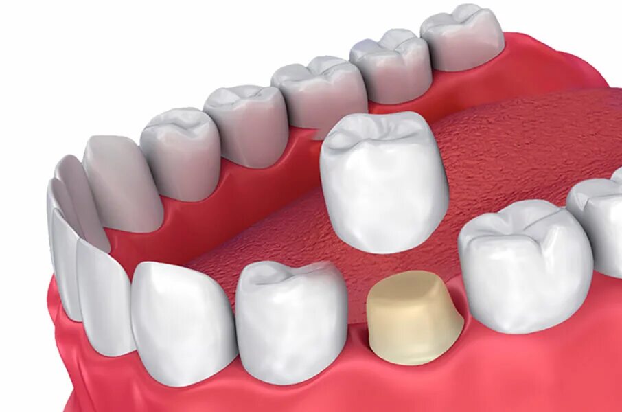 Dental Zircon Crown. Зубная коронка. Керамическая коронка.