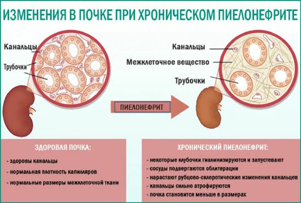 Изменения при пиелонефрите. Фиброз паренхимы почек. первичное сморщивание почки. почка при хроническом пиелонефрите.