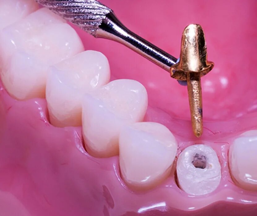 Штифт зубной анкерный. Металлокерамическая коронка на штифте. 502. Анкерные штифтовые конструкции (анкер+композит);. Корневой анкерный штифт.