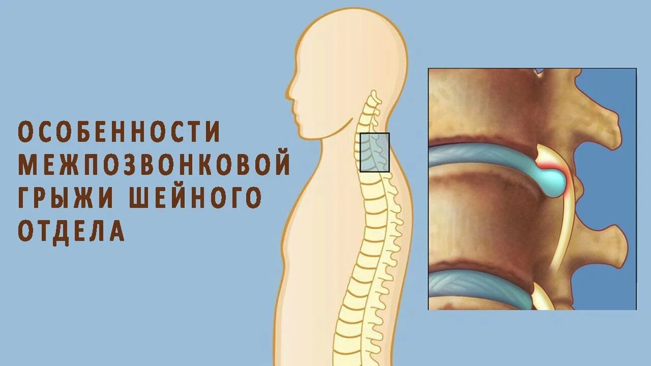 Грыжа шеного от. Межпозвоночная грыжа шейного отдела.