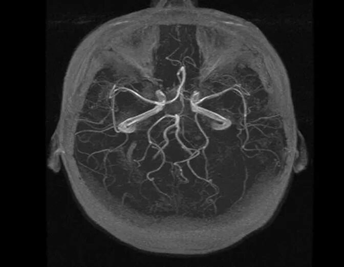 Виллизиев круг на кт. Трифуркация левой ВСА мрт. Незамкнутый Виллизиев круг мрт. Задняя трифуркация кт.