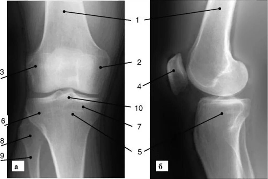 Два мыщелка. Анатомия большеберцовой кости рентген. Рентген коленного сустава сбоку. Рентген большеберцовой кости норма. Коленный сустав рентген норма.