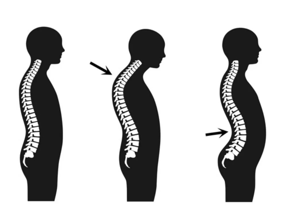 кифоз у женщины