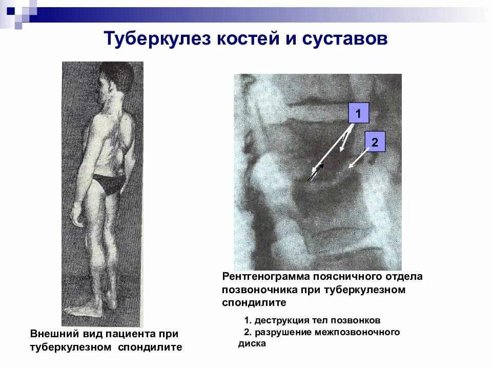 Коленный туберкулез