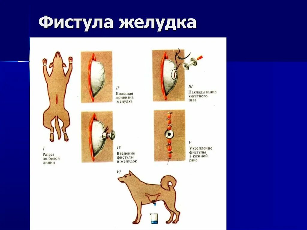 Фистула. Артерио-венозная фистула.