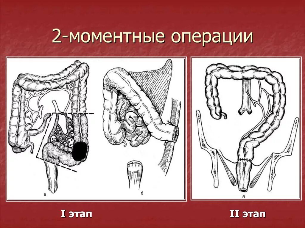 Опущение поперечно-ободочной кишки. Опущение поперечной ободочной кишки. Неотложная хирургия ободочной кишки.