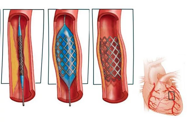 Инфаркт коронарное стентирование. Атеросклероз сосудов сердца стентирование. Коронарное стентирование сосудов сердца. Эндоваскулярная баллонная ангиопластика.
