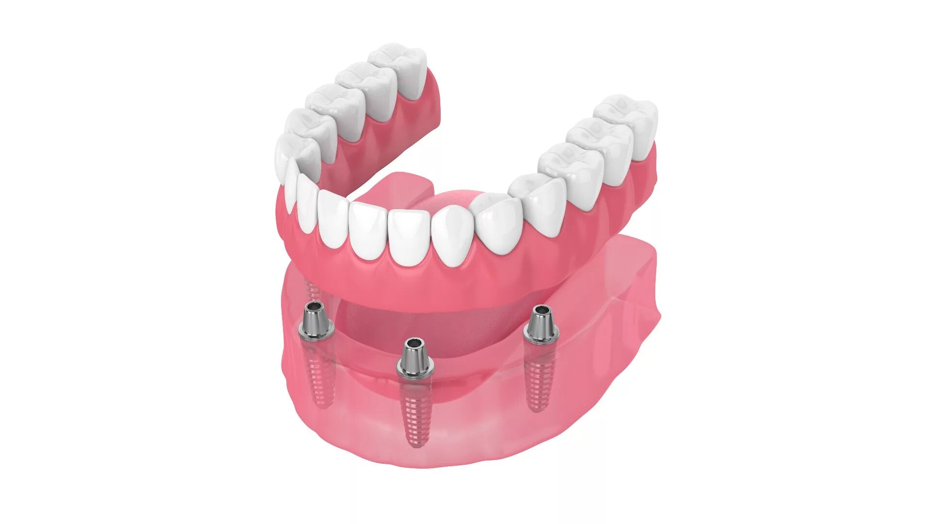 Протезирование зубов инвалиду 1 группы. Имплантация всей челюсти all on 4. All on 4 (имплантация Osstem + временное протезирование). Имплантация челюсти на 4 имплантах.