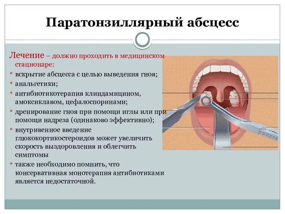 Тонзиллит хронический лечение народная. Паратонзиллярный абсцесс тризм. Патогенез паратонзиллярного абсцесса. Наружный паратонзиллярный абсцесс вскрытие.