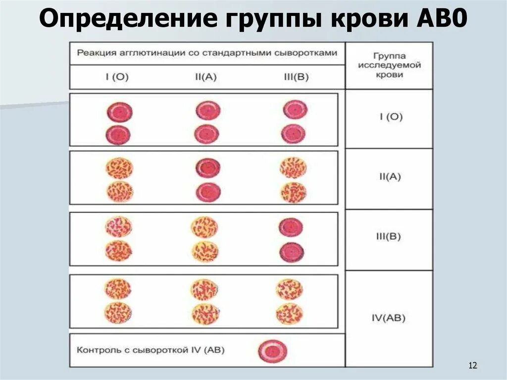 2 группа крови определение. Схема реакции агглютинации группы крови. Реакция агглютинации для определения группы крови. Сыворотка агглютинации 1 и 3 группы крови. Реакция агглютинации при определении группы крови.