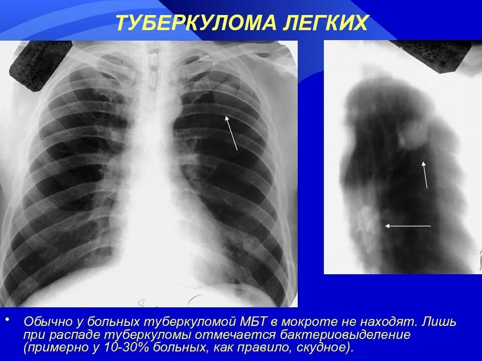 Операция левого легкого. Туберкулема фтизиатрия. Солитарная слоистая туберкулема. Туберкулема верхней доли. Туберкулема в фазе распада.