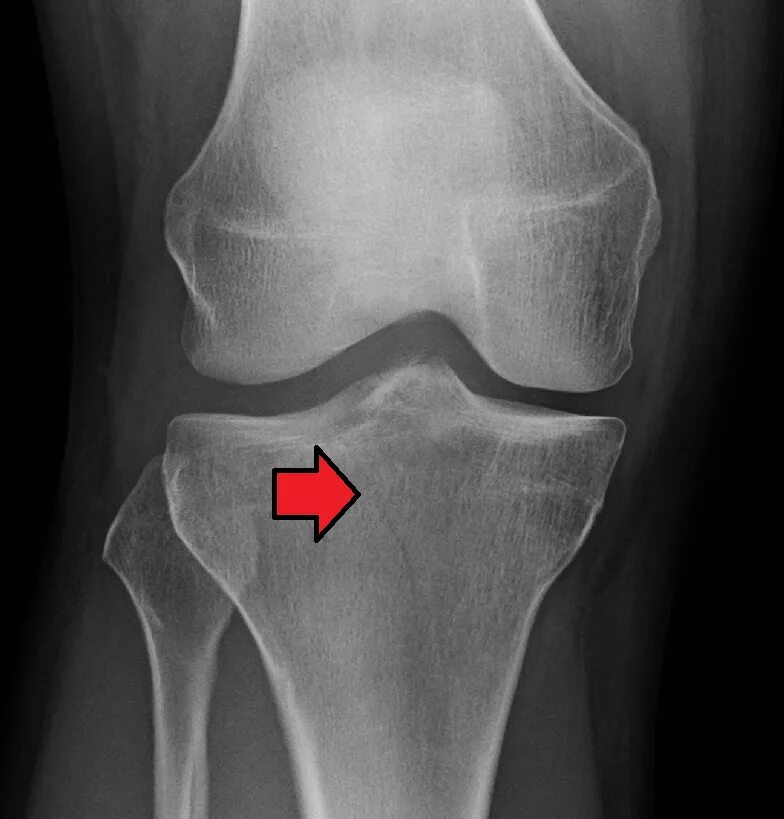 Мыщелка ноги. Перелом плато большеберцовой кости. Перелом коленной чашечки рентген. Перелом надколенника рентген. Вывих надколенника рентген.