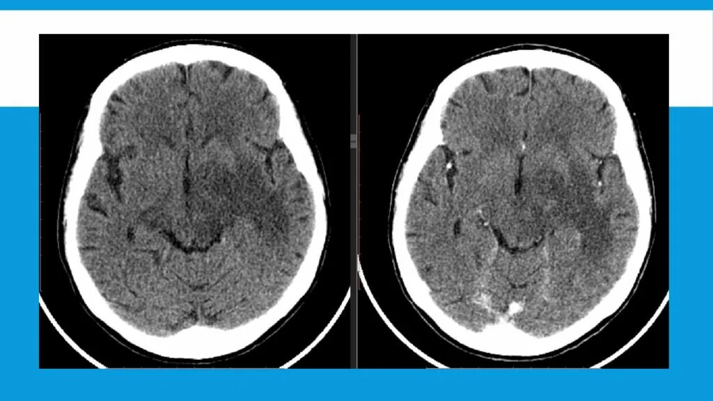 Цитотоксический отек головного мозга кт. Вазогенный отек головного мозга кт.