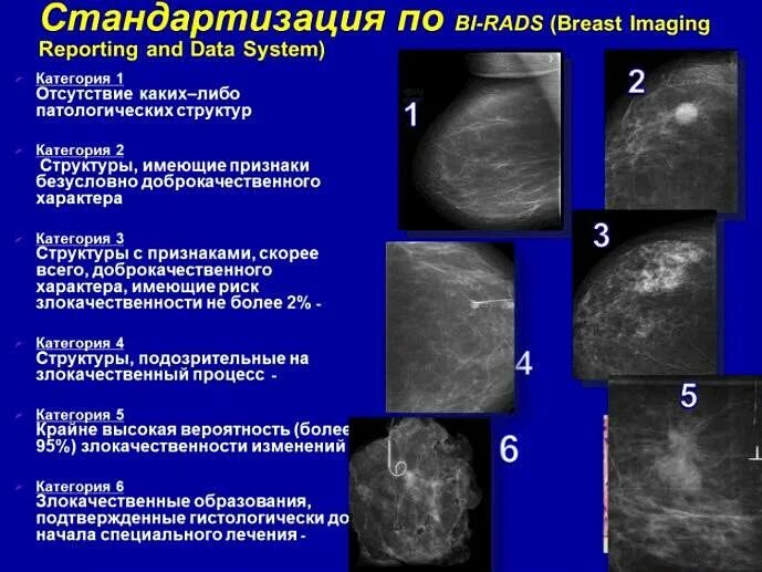 Диффузно фиброзная мастопатия bi rads 2. Фиброзно кистозная мастопатия молочной железы bi-rads-4a. УЗИ молочных желез bi rads. Бирадс УЗИ молочной железы. Классификация образований молочной железы.