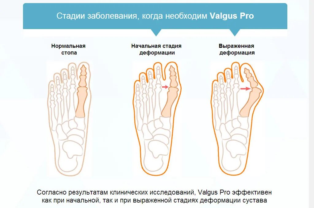 Как правильно вставлять пальцы. Вальгус деформация большого пальца стопы. Классификация вальгусной деформации 1 пальца стопы. Вальгусная деформация пальца степени. Вальгусная деформация 1 пальца стопы.