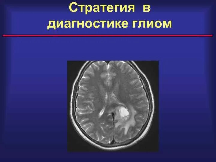 Что такое глиома. Томография глиомы головного мозга. Глиома зрительного нерва.