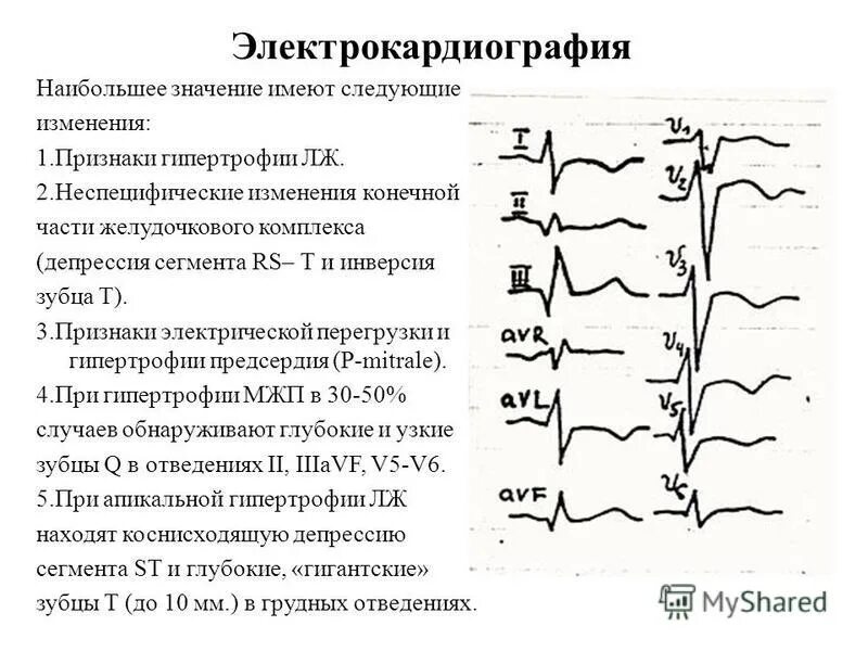 Что значит изменения зубца т