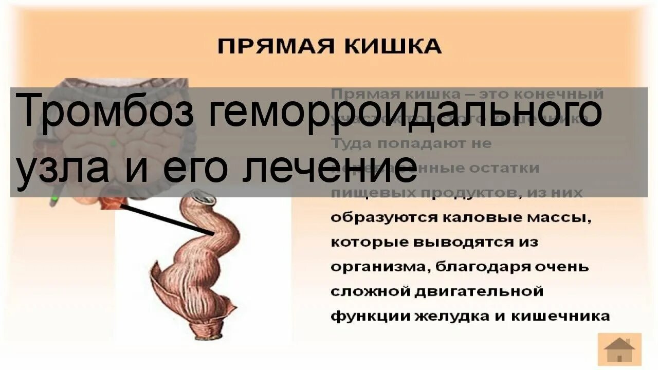 Причина кровотечения из заднего прохода у мужчин. Тромбоз наружных геморроидальных узлов. Тромбированный узел геморрой. Тромбированный наружный геморроидальный узел. Геморроидальное кровотечение.