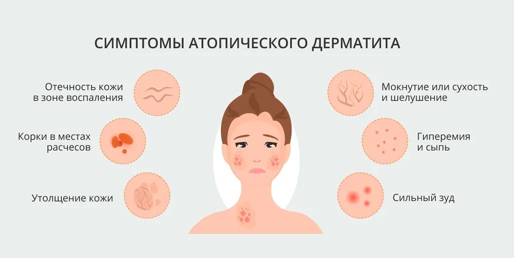 Атопический дерматит у детей атд. Атопический дерматит схема кожи. аллергический дерматит характерные симптомы. скарлатинозный дерматит.
