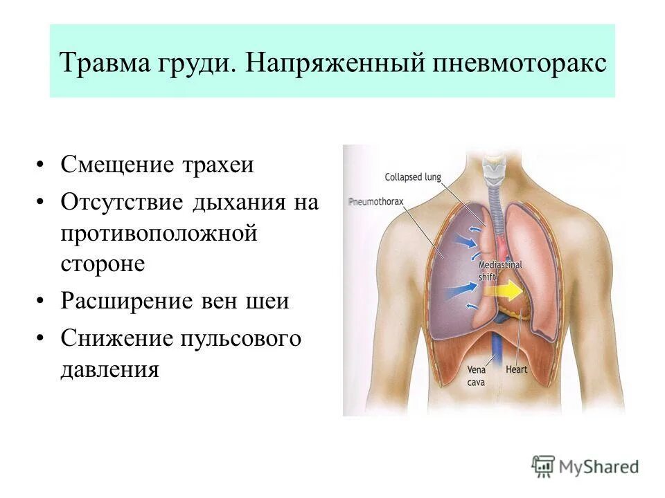 Напряженный пневмоторакс помощь