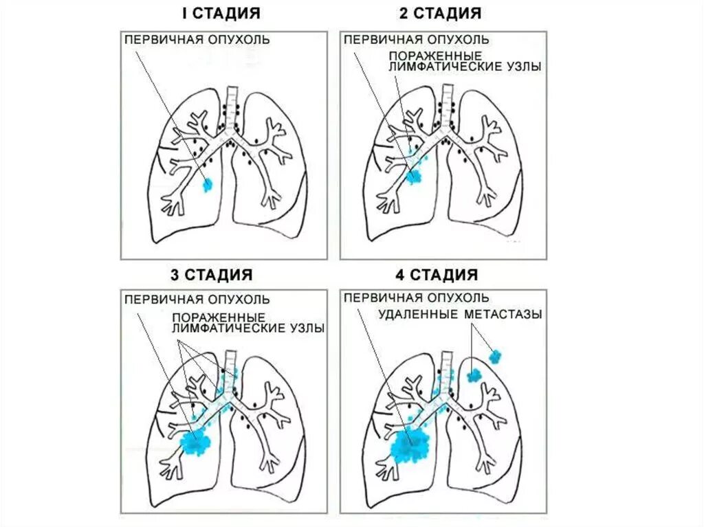 Рак легкого симптомы сколько живут. Степени поражения легких раковых. Онкология легких стадии. Степени онкологии легких. Стадии онкологии легкого.