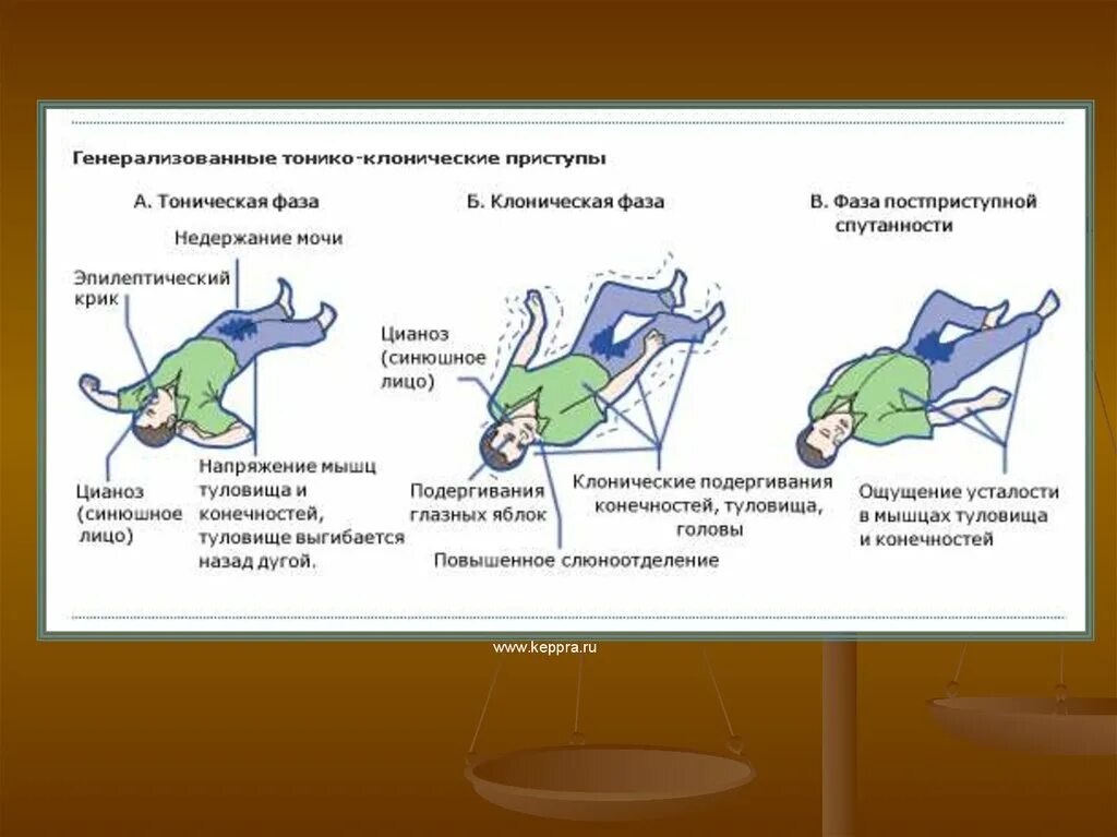 Клоническая фаза эпилептического припадка. Тонико-клонические приступы. Тонические и тонико клонические судороги. Клонические приступы эпилепсии. Тонико клонические припадки