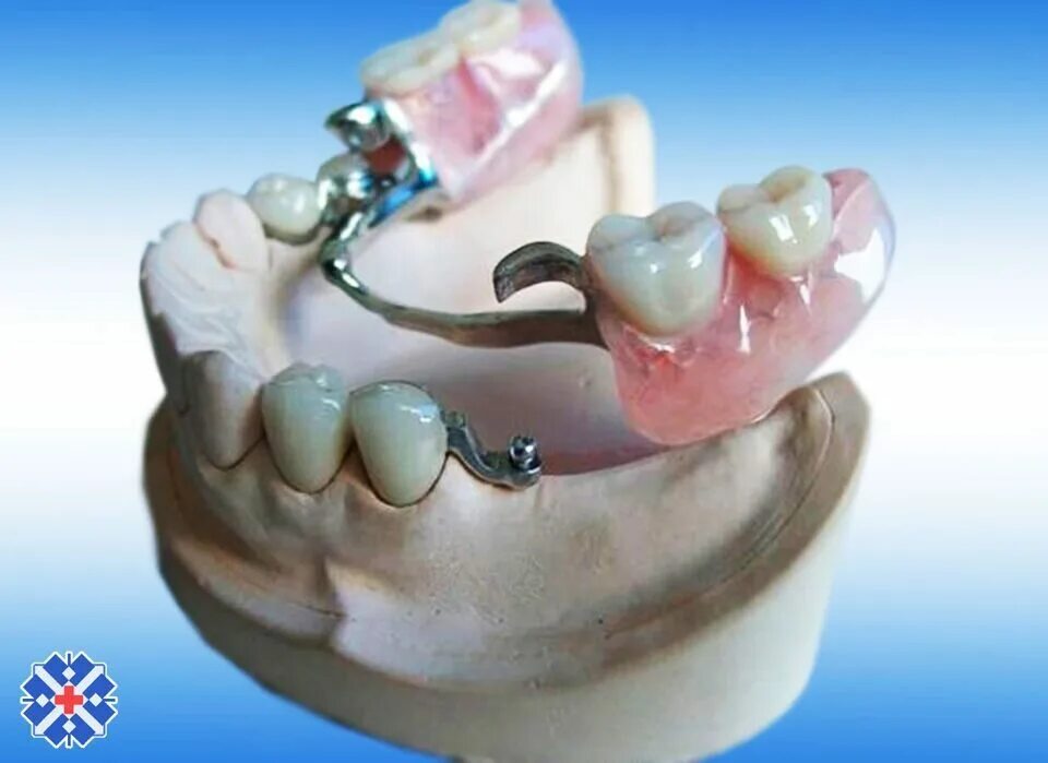 форма бюгельного протеза. форма бюгельного протеза. форма бюгельного протеза. бюгельный протез ортопедическая стоматология. телескопический бюгельный протез.