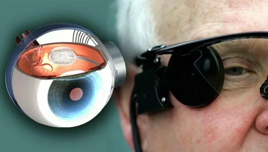 Argus ii. Бионический глаз argus ii. бионический глаз argus. искусственная сетчатка argus ii. бионический протез argus ii.