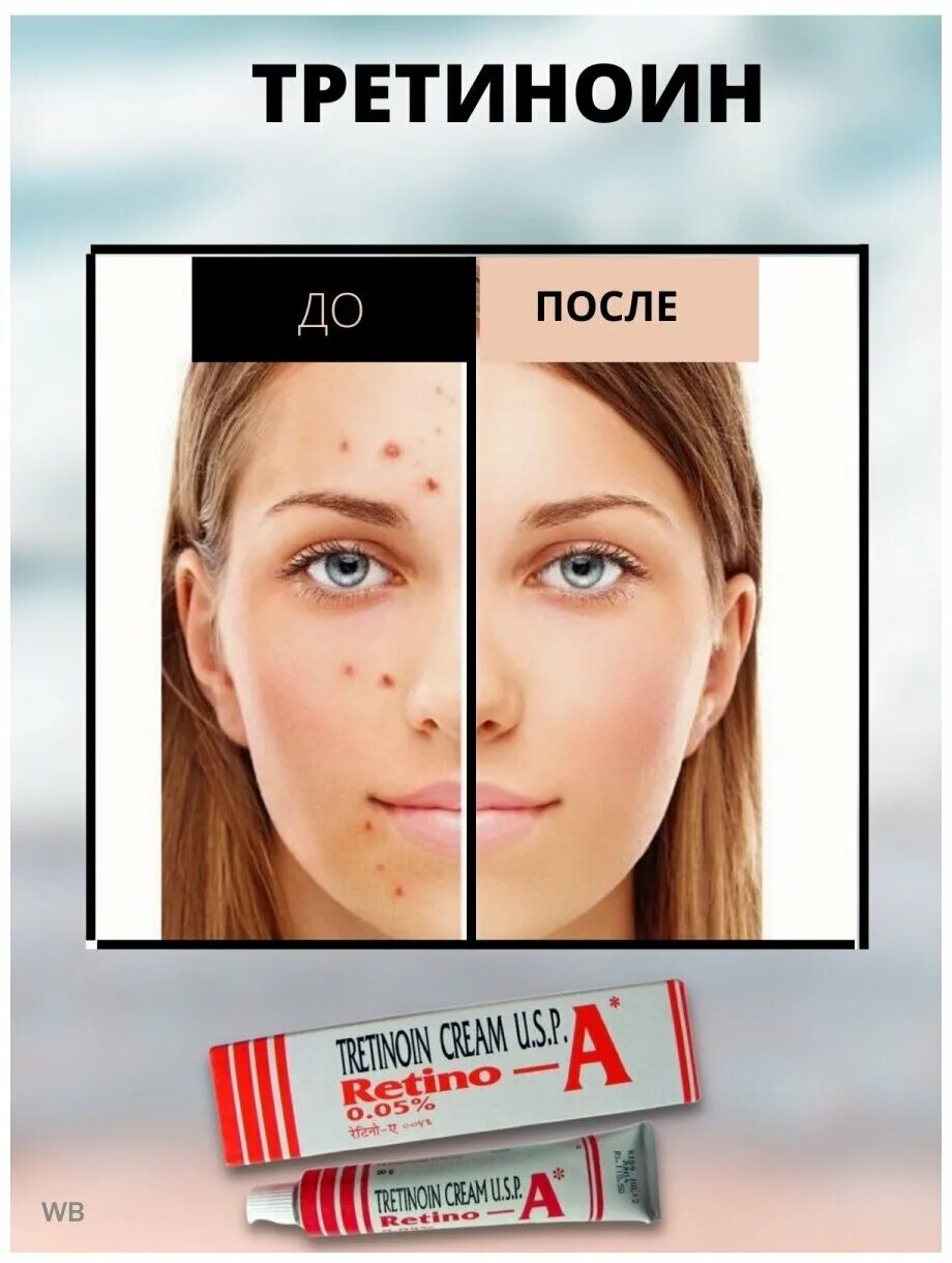 Retin a крем. третиноин пилинг для лица. Menarini третиноин гель. третиноин омолаживание кожи. ретинол индия для кожи.