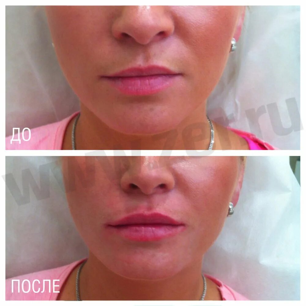 Асимметрия губ после филлера. Исправление асимметрии лица филлерами. Исправление асимметрии губ. Асимметрия после увеличения. Увеличение верхней губы.