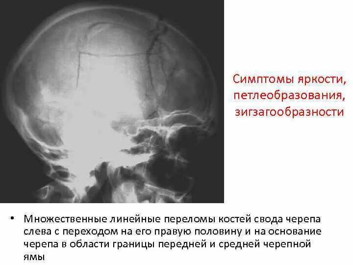 Перелом кости свода черепа. Перелом затылочной кости черепа рентген. Вдавленный перелом костей черепа рентген. Перелом основания черепа симптомы рентген. Перелом затылочной кости черепа симптомы.