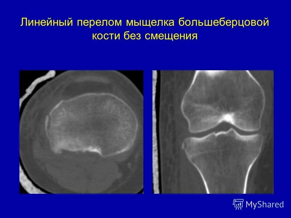 Импрессионный перелом мыщелка. Импрессионный перелом кт. Внутрисуставной импрессионный перелом мыщелка. Импрессионный перелом пяточных костей.