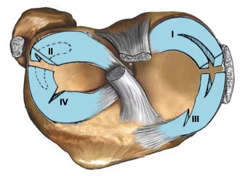 Менископатия медиального мениска. Разрыв рога медиального мениска. Горизонтальный разрыв медиального мениска. Задний Рог медиального мениска. Повреждение переднего рога