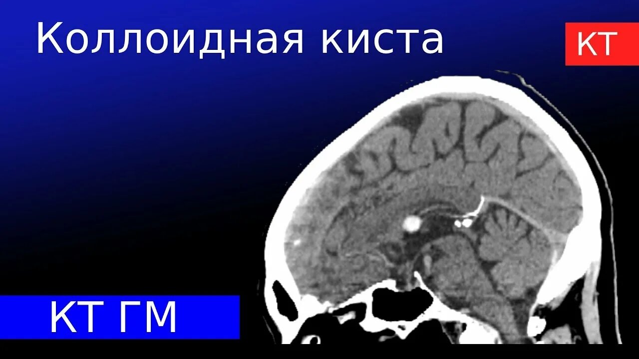 Коллоидная киста 3 желудочка мрт. Коллоидная киста 3 желудочка кт.