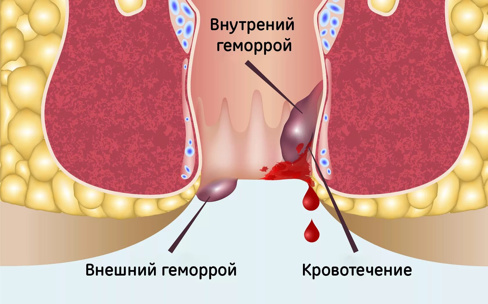 Почему не проходит геморрой при лечении