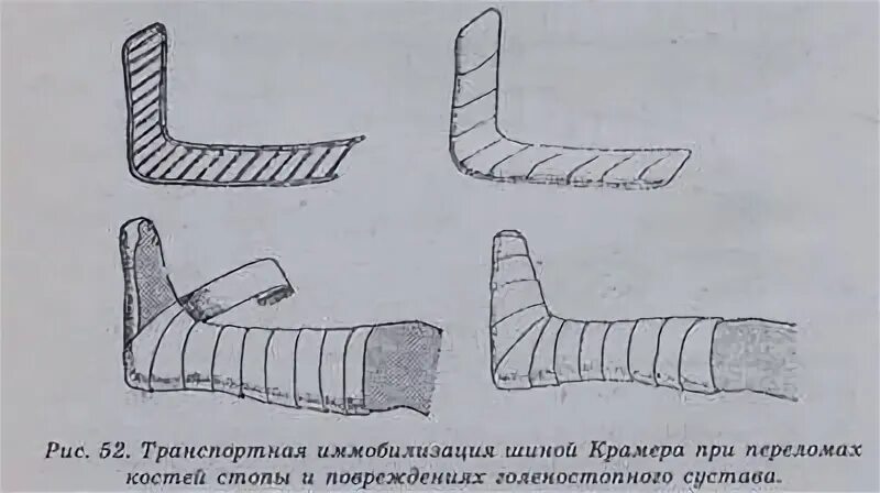 Перелом голеностопного сустава иммобилизация