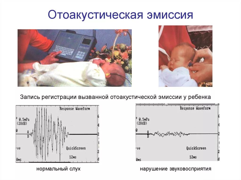 Прибор отоакустической эмиссии. Отоакустическая эмиссия скрининг у новорожденных. Отоакустическая эмиссия при нейросенсорной тугоухости. Тест отоакустической эмиссии расшифровка у детей норма. Аудиологический скрининг новорожденного.