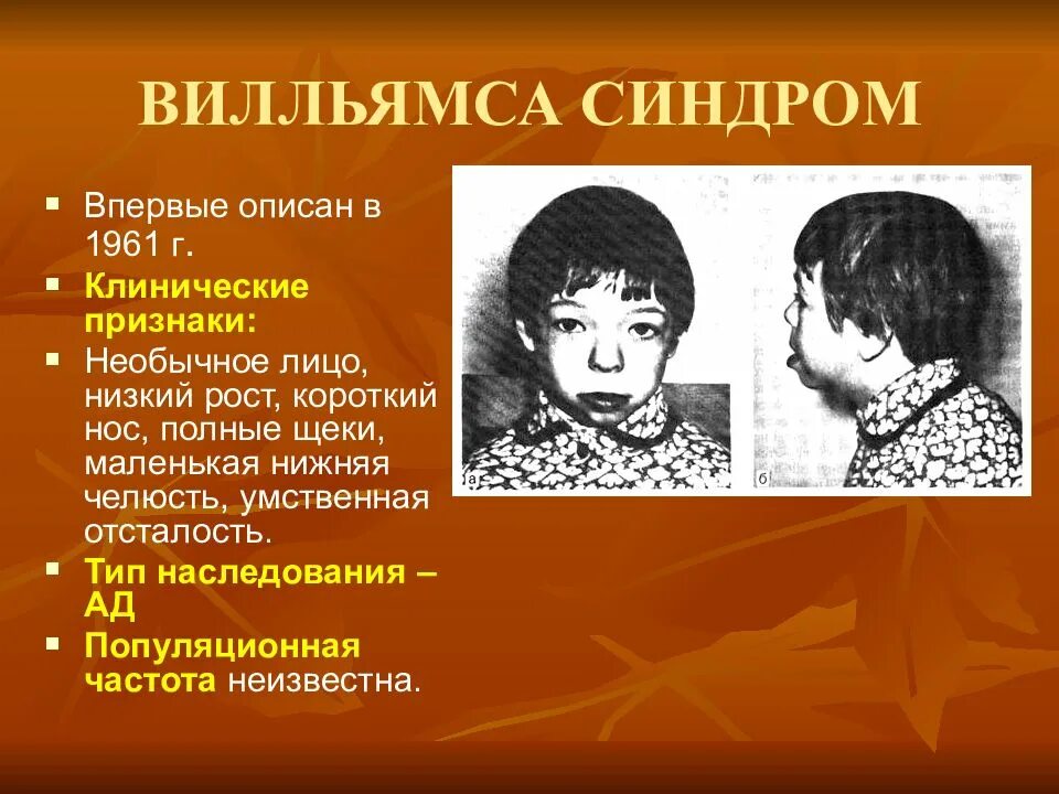 Синдром умственной отсталости. Генетические заболевания лица. генетические синдромы человека. синдром вильямса тип наследования.