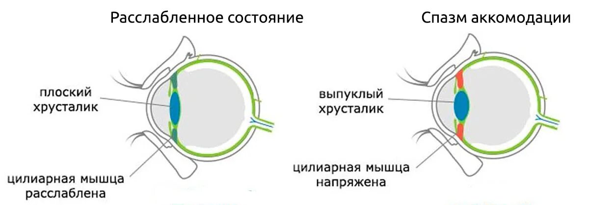 Мышцы аккомодации. Спазм (ложная близорукость). Спазм цилиарной мышцы глаза симптомы. Спазм аккомодации глаз симптомы. Спазм аккомодации у детей.