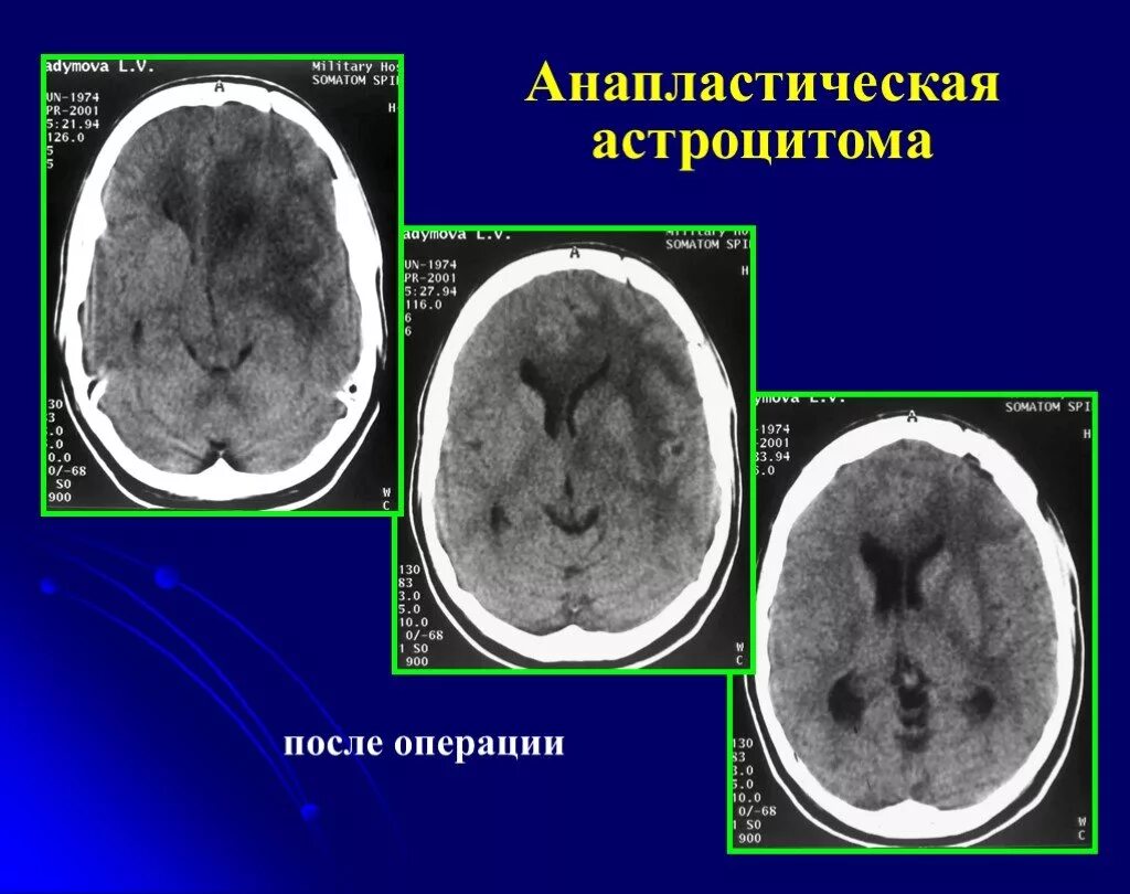 Кт-цистернография методика. Астроцитома лобной доли. Анапластическая астроцитома. Анапластическая астроцитома кт. Диффузная астроцитома