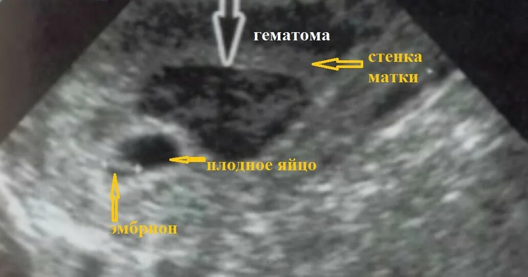 Плод в полости матки. Ретрохориальная гематома беременность. Ретрохориальная гематома на УЗИ. Преждевременная отслойка нормально расположенной плаценты УЗИ. Ретроамниотическая гематома ретрохориальная гематома.