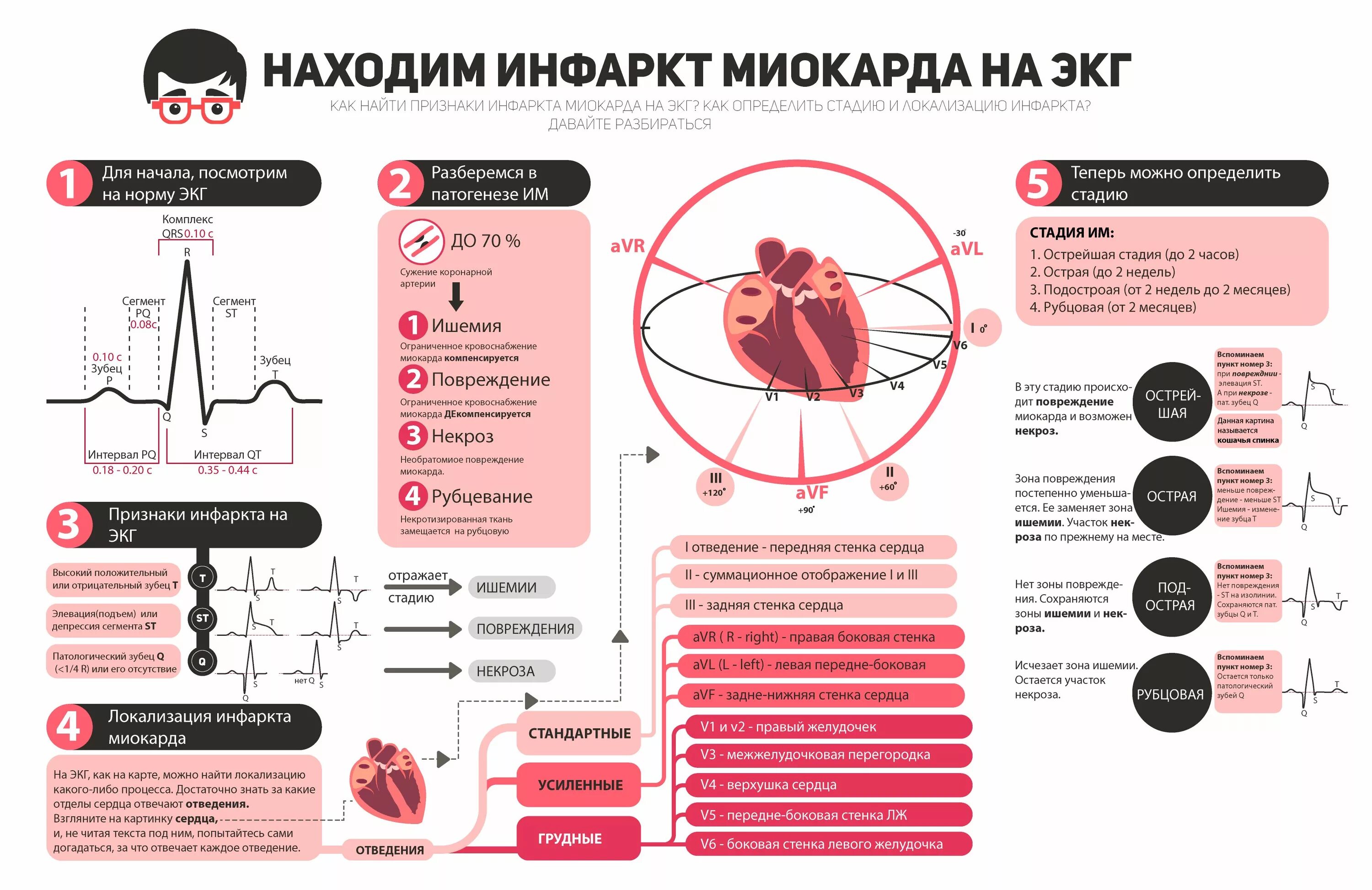 Локализация инфаркта по ЭКГ. Локализация инфаркта миокарда по ЭКГ. ЭКГ диагностика инфаркта миокарда по стадиям. Стадия и локализация инфаркта миокарда на ЭКГ. Зона ишемии