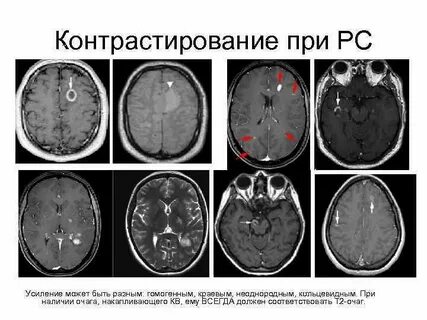 Очаги копят контраст