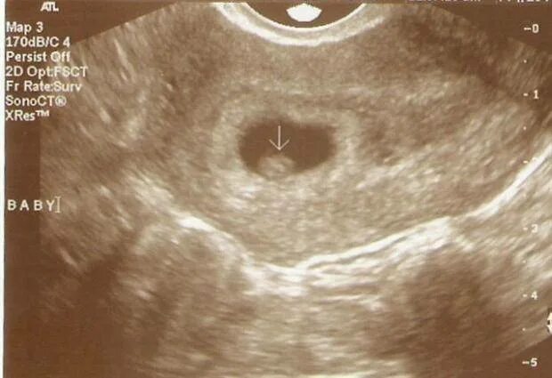 Беременность 3 недели после зачатия. Эмбрион 2-3 недели как выглядит. Плод на 3 неделе беременности от зачатия. Плод в 3 недели беременности на УЗИ. Как выглядит зародыш в 3 недели.
