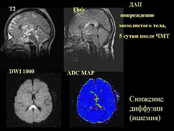 Диффузное аксональное повреждение мрт мозолистого тела. Диффузное аксональное повреждение кт. Диффузные аксональные повреждения головного мозга мрт. Поражение валика мозолистого тела. Диффузная травма мозга