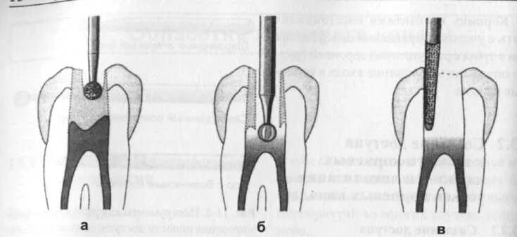 Препарирование корневого канала. Этапы вскрытия полости зуба эндодонтия. Вскрытие полости зуба эндодонтия. Препарирование челюсти препарирование.