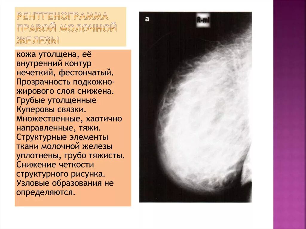 Образование молочной. Образование молочной железы. Узловое образование молочной железы. Узелковое образование в молочной железе. Бугристое образование в молочной железе.