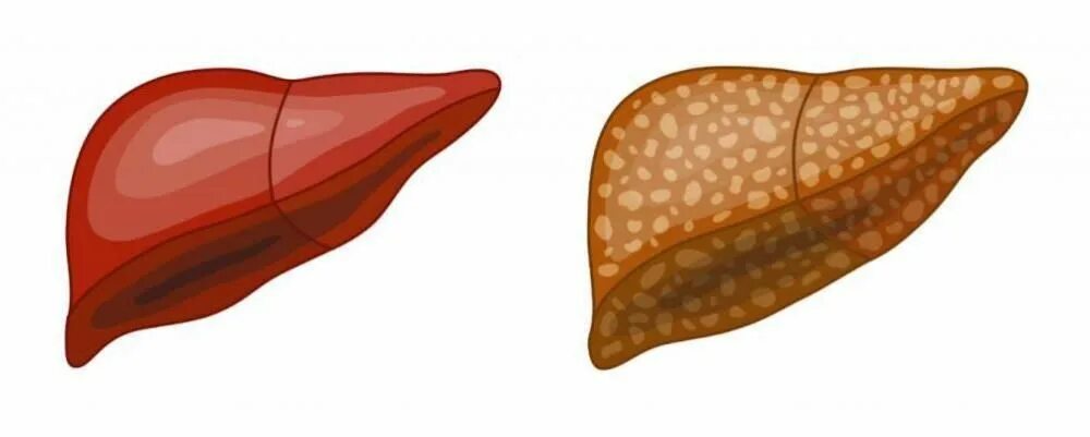 Печень больная жировой. Неалкогольный жировой гепатоз. Жировой гепатоз (стеатоз) печени. Жировой гепатоз печени рисунок.