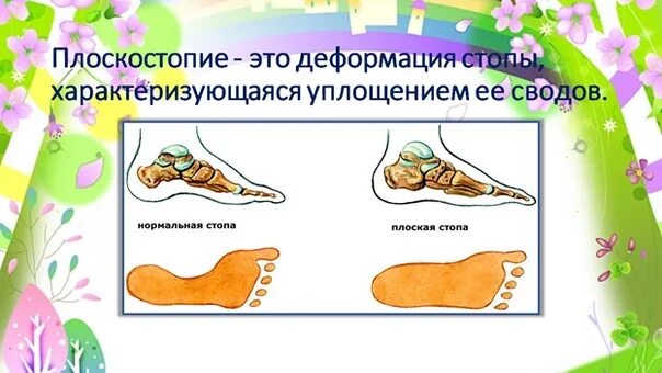 Плоскостопие может быть предотвращено
